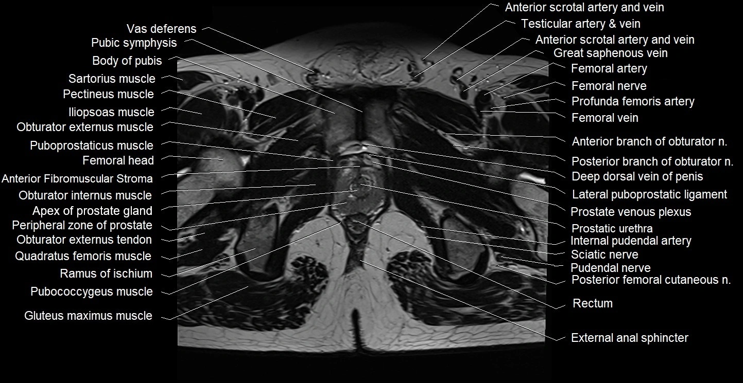 Male pelvis axial cross sectional anatomy image 36.webp